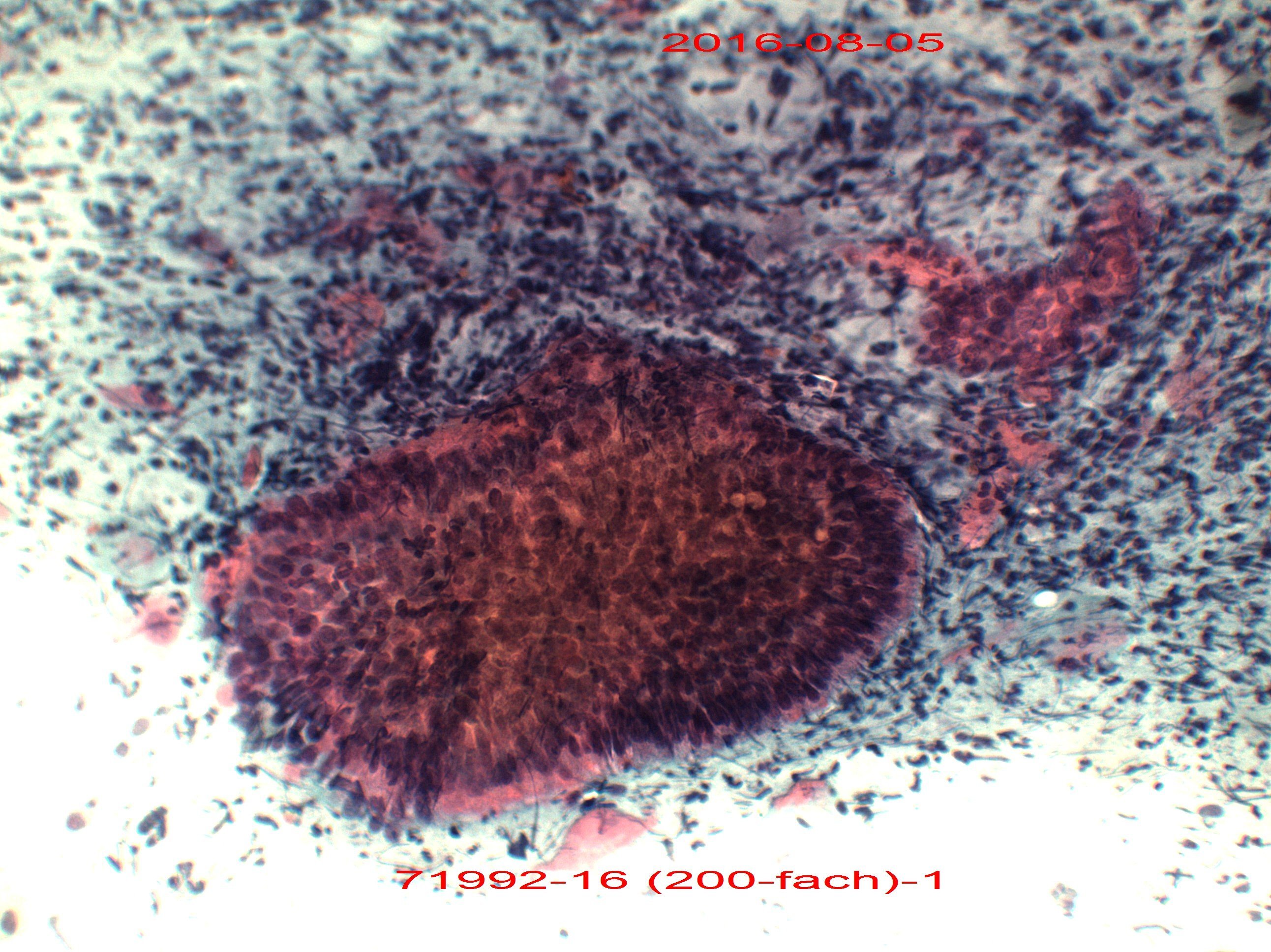 Pap III-g/III-p